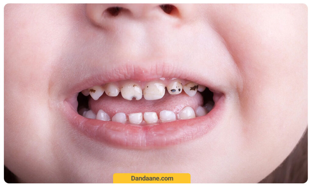 وجود نقطه های سیاه بر روی دندان کودک