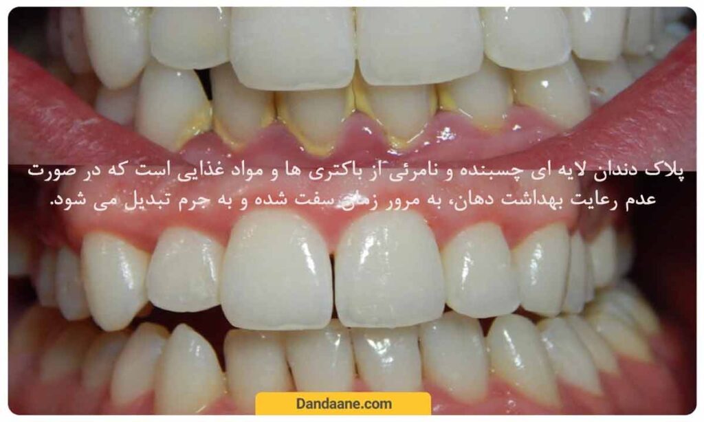 جرمگیری دندان 