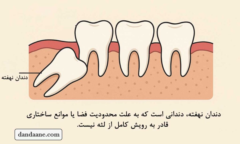 دندان نهفته چیست؟