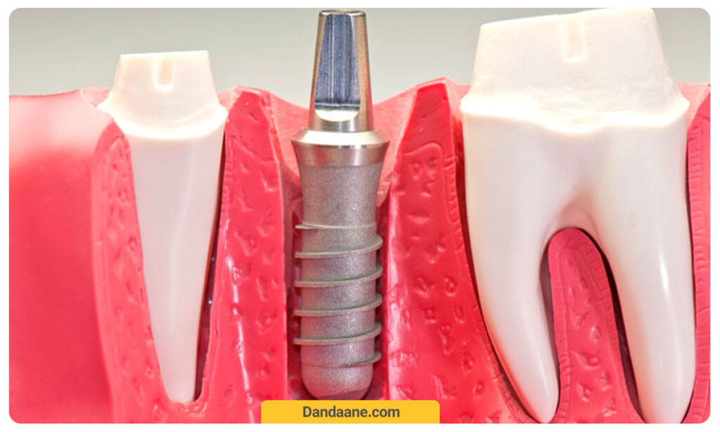 مرحله سوم ایمپلنت دندان