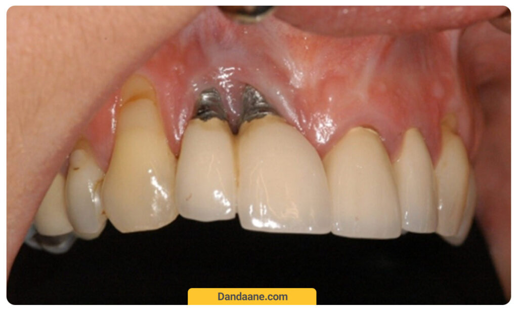 شل شدن ایمپلنت دندان