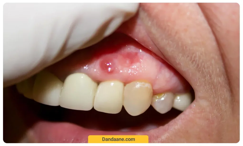 عکسی از معاینه دندانپزشک برای درمان عفونت لثه