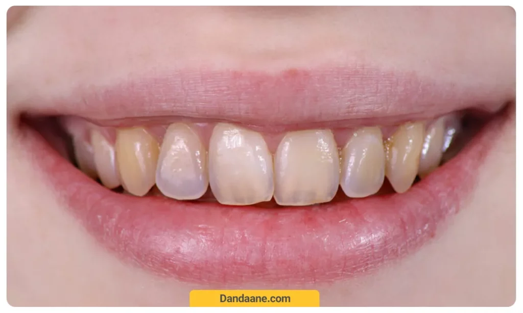 عکسی از شیشه ای شدن لبه های دندان