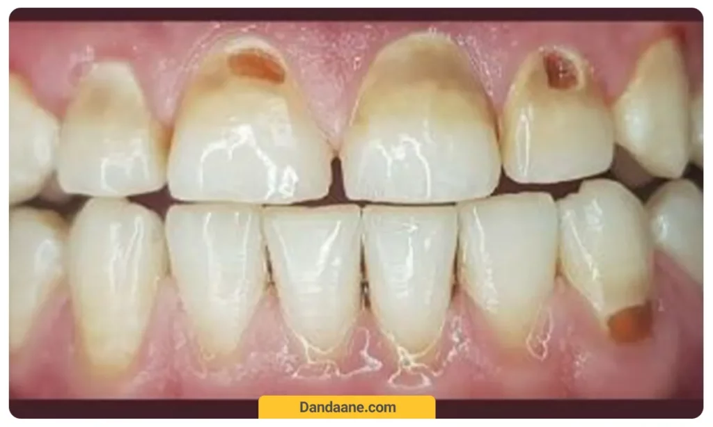 تحلیل مینای دندان