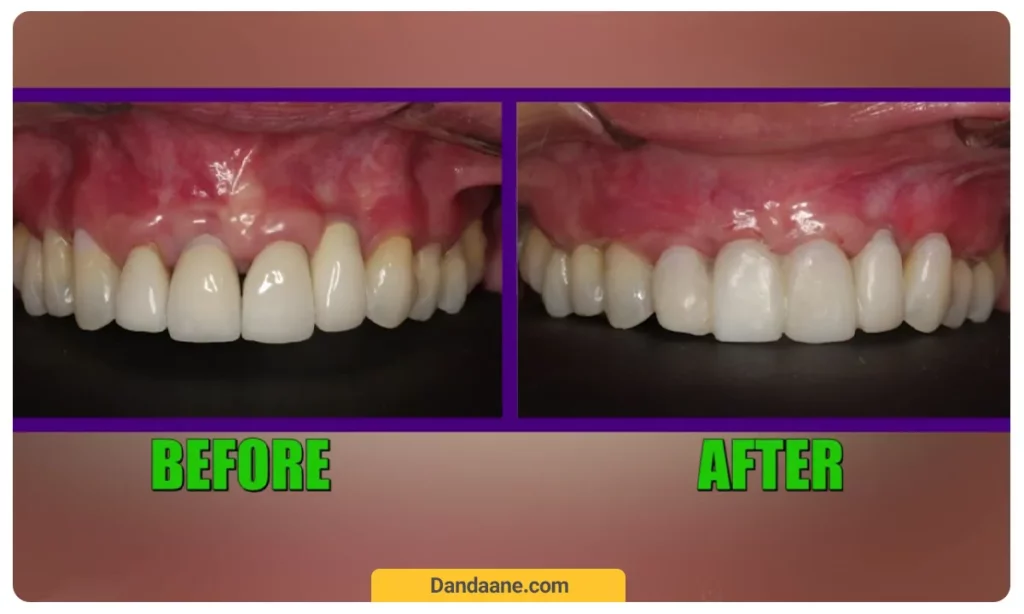 قبل و بعد تحلیل لثه بعد از ایمپلنت