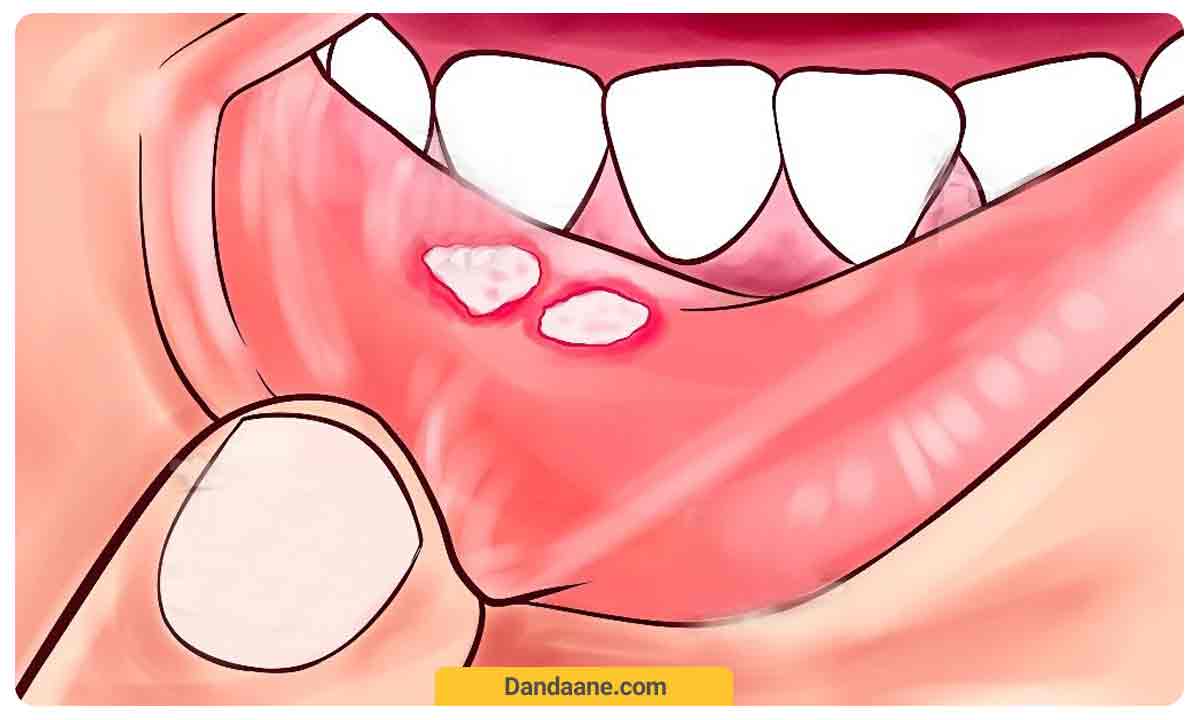 آفت دهانی در در قسمت داخله لب
