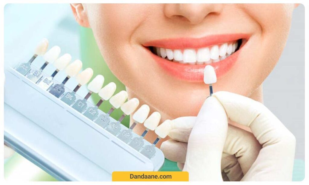 سفید کردن دندان ها با روش کامپوزیت