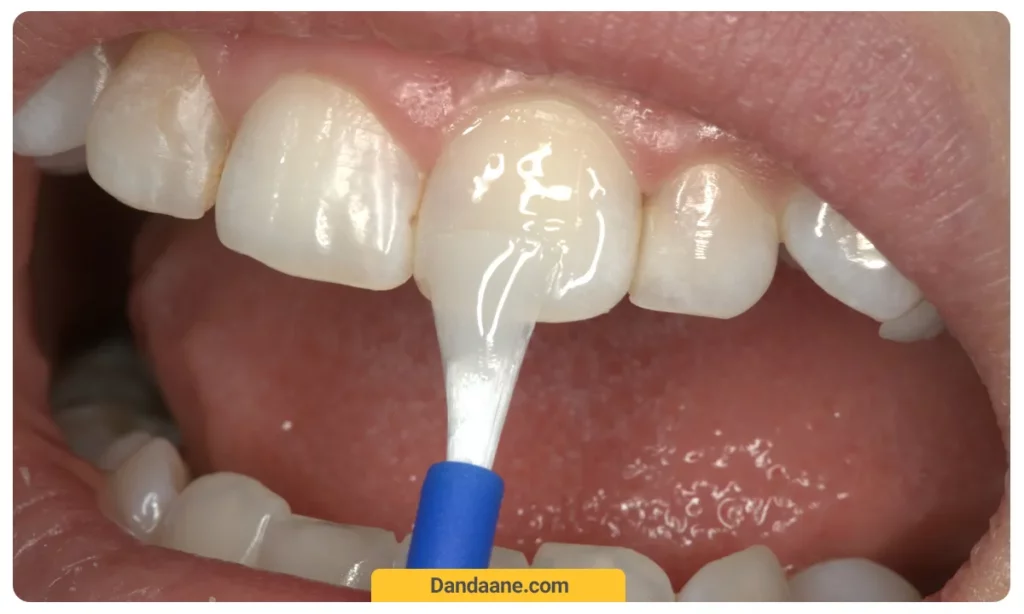 فلورایدتراپی دندان
