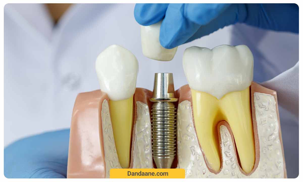 ایمپلنت دندان چگونه انجام می شود