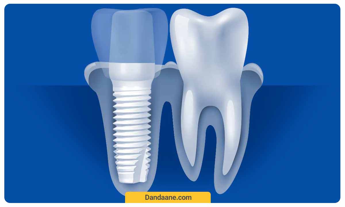 فواید ایمپلنت دندان