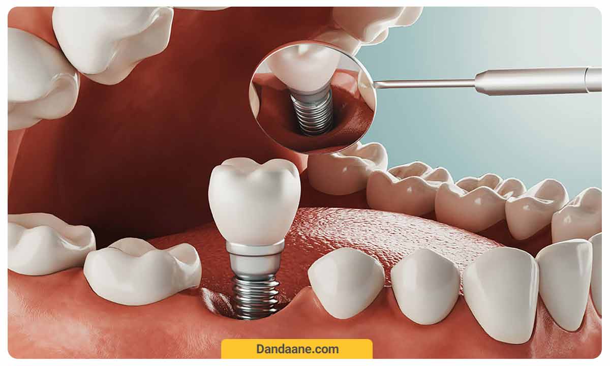 نمای قسمت های مختلف ایمپلنت دندان قرار گرفته در لثه