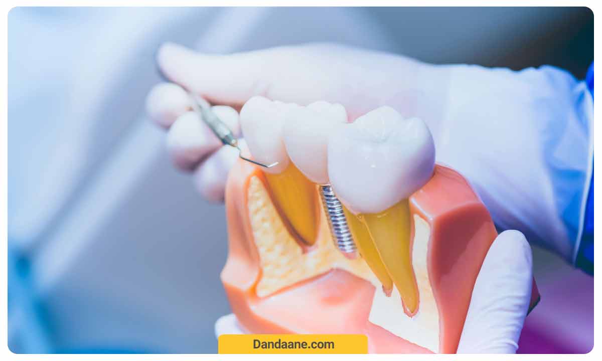 کاندیدای مناسب ایمپلنت دندان