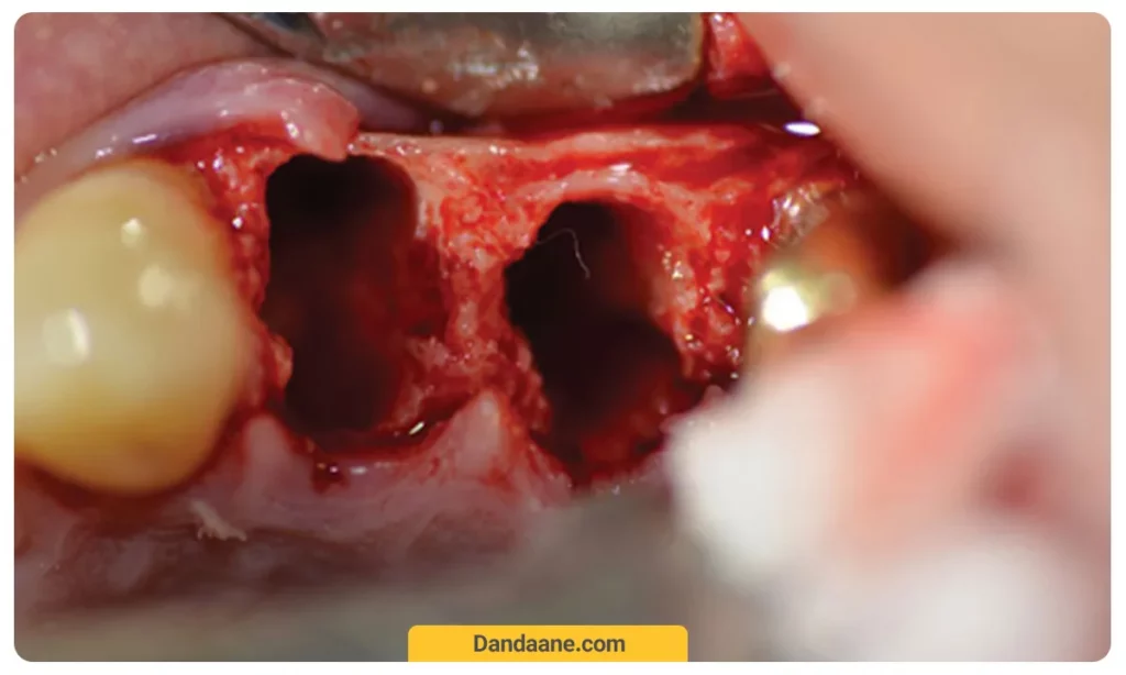 تحلیل رفتن لثه بعد از کشیدن دندان