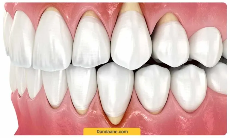 عکس شماتیک تحلیل لثه