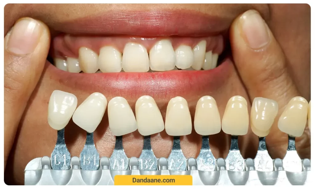 بهترین رنگ کامپوزیت روکش دندان