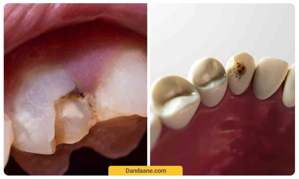 پوسیدگی دندان چگونه اتفاق می افتد