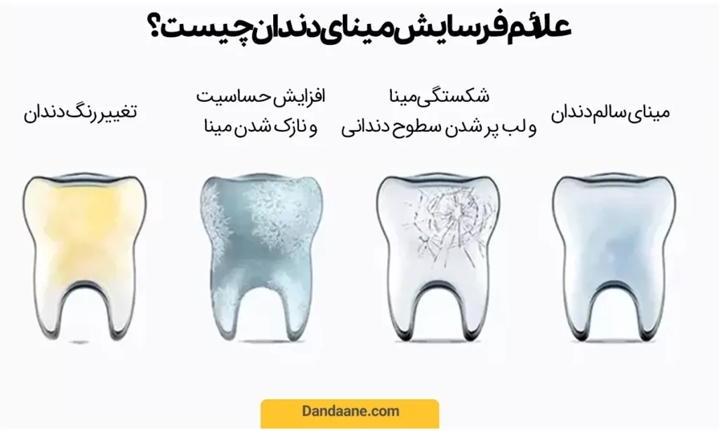 علائم فرسایش مینای دندان چیست