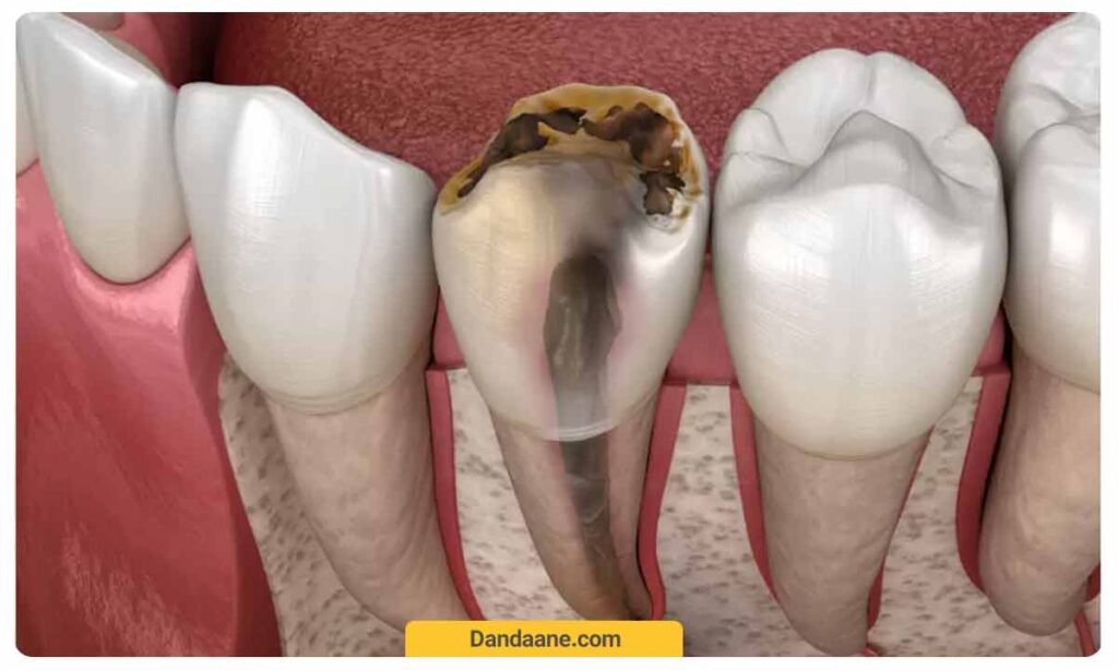 دندان مرده چیست؟