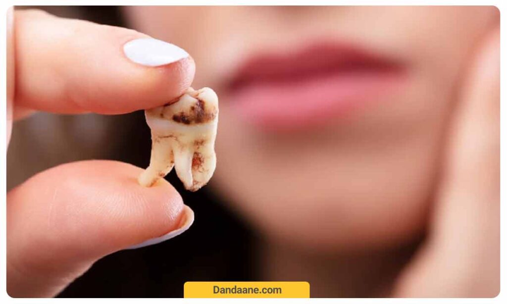 نشانه های دندان مرده چیست؟