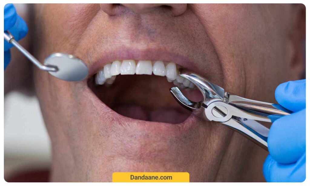 آسیب های بعد از کشیدن دندان