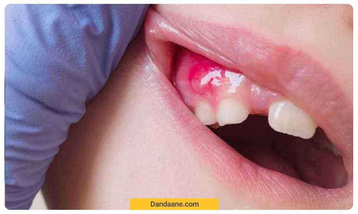 ایجاد لخته خون بر اثر آبسه دندان