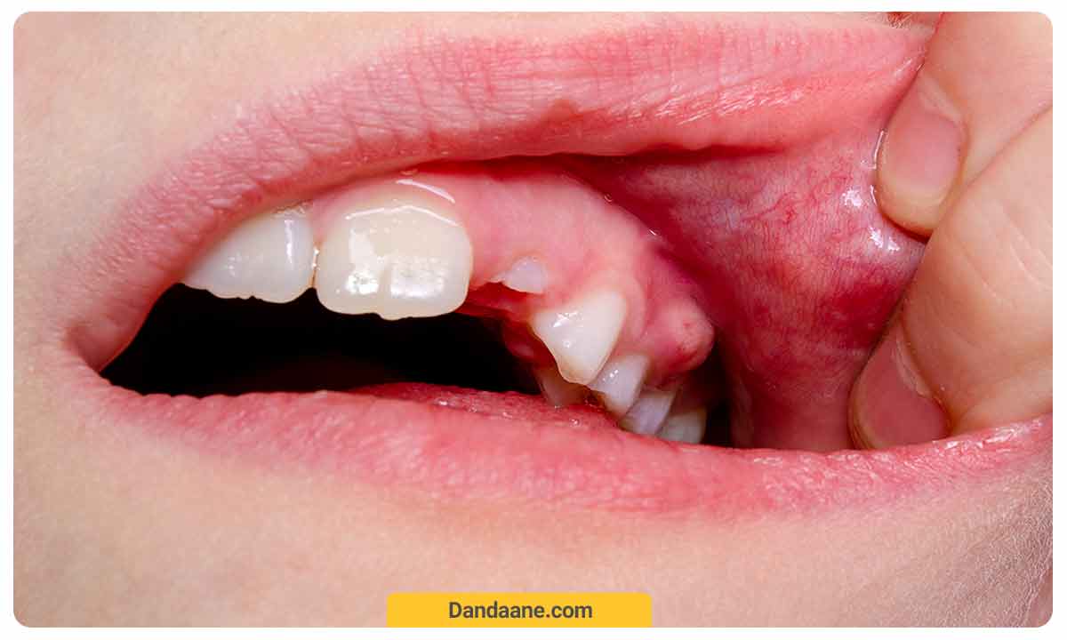 عوارض آبسه دندان