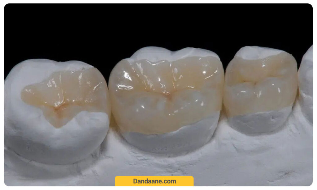 عکس اینله و لنه دندان
