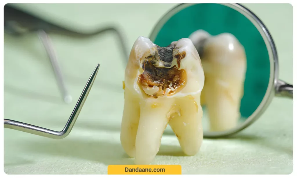 خارج کردن پالپ آسیب دیده دندان