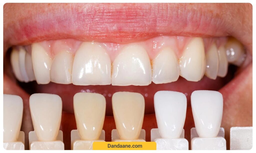 طیف رنگی کامپوزیت IPS