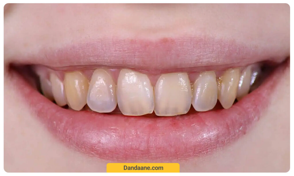 عکس از فرسایش مینای دندان