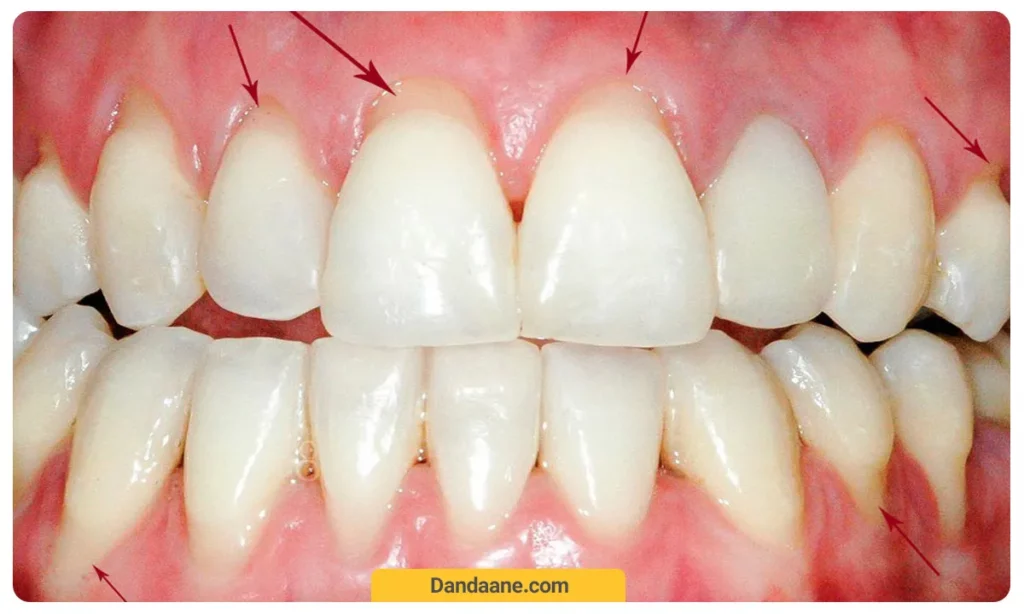 عکس تحلیل لثه