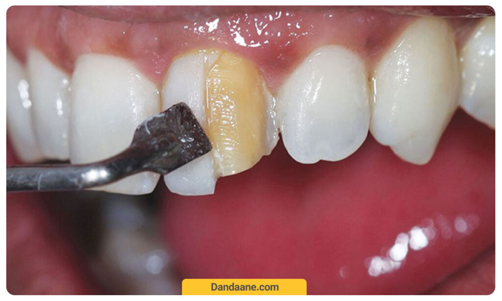 عکس رزین کامپوزیت