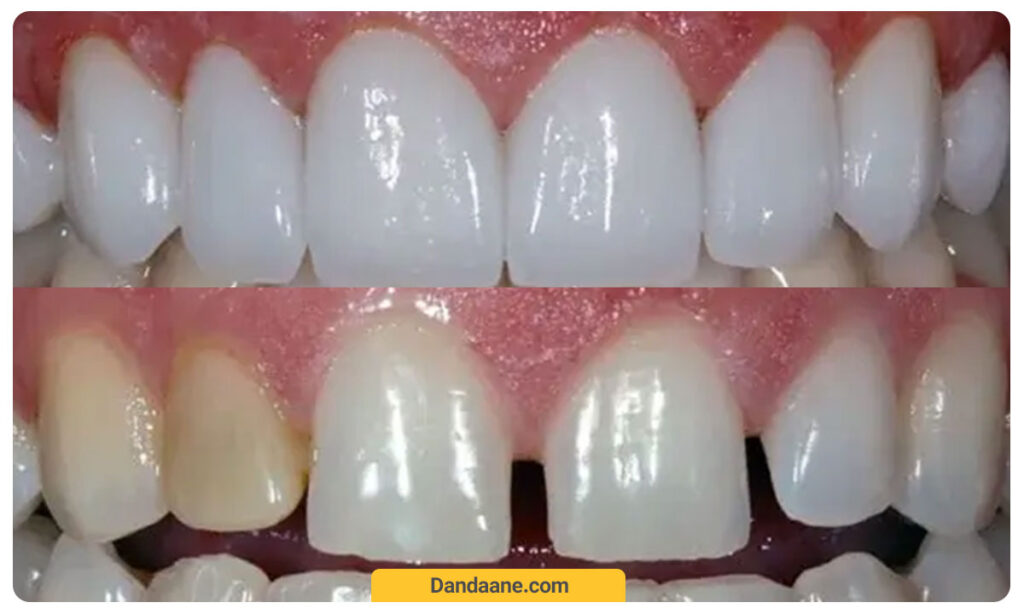 عکس قبل و بعد ونیر کامپوزیت دندان