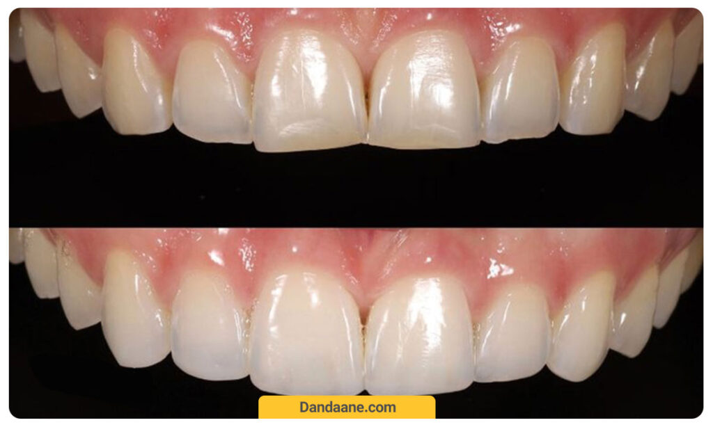 عکس کامپوزیت دندان قبل و بعد