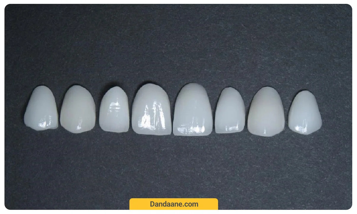 لمینت 8 دندان جلو