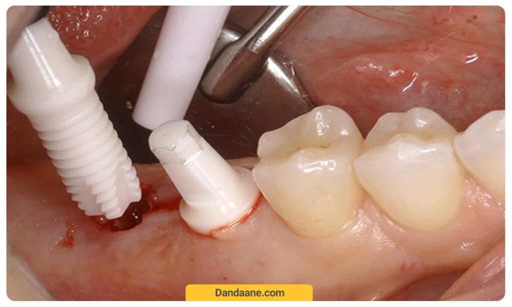 نصب ایمپلنت دندان تک مرحله ای