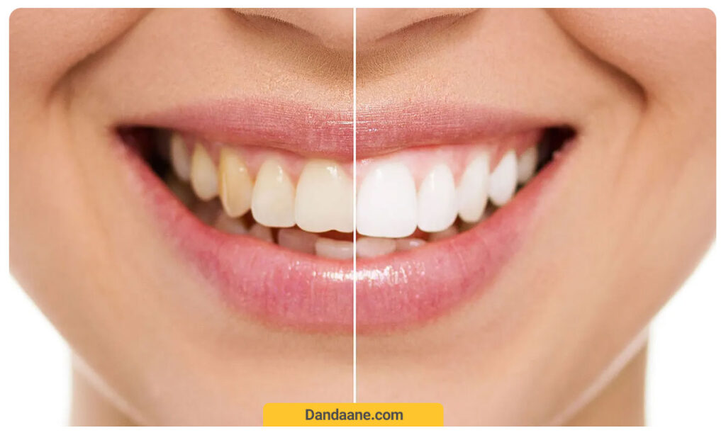 کاندیدای مناسب کامپوزیت دندان چه کسانی هستند؟