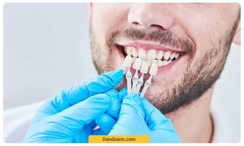 انتخاب بهترین رنگ لمینت دندان