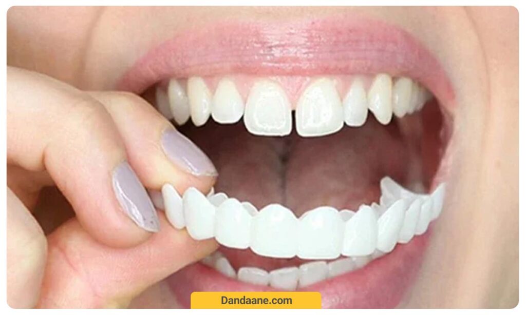 عکسی از نصب لمینت های اولیه موقتی دندان