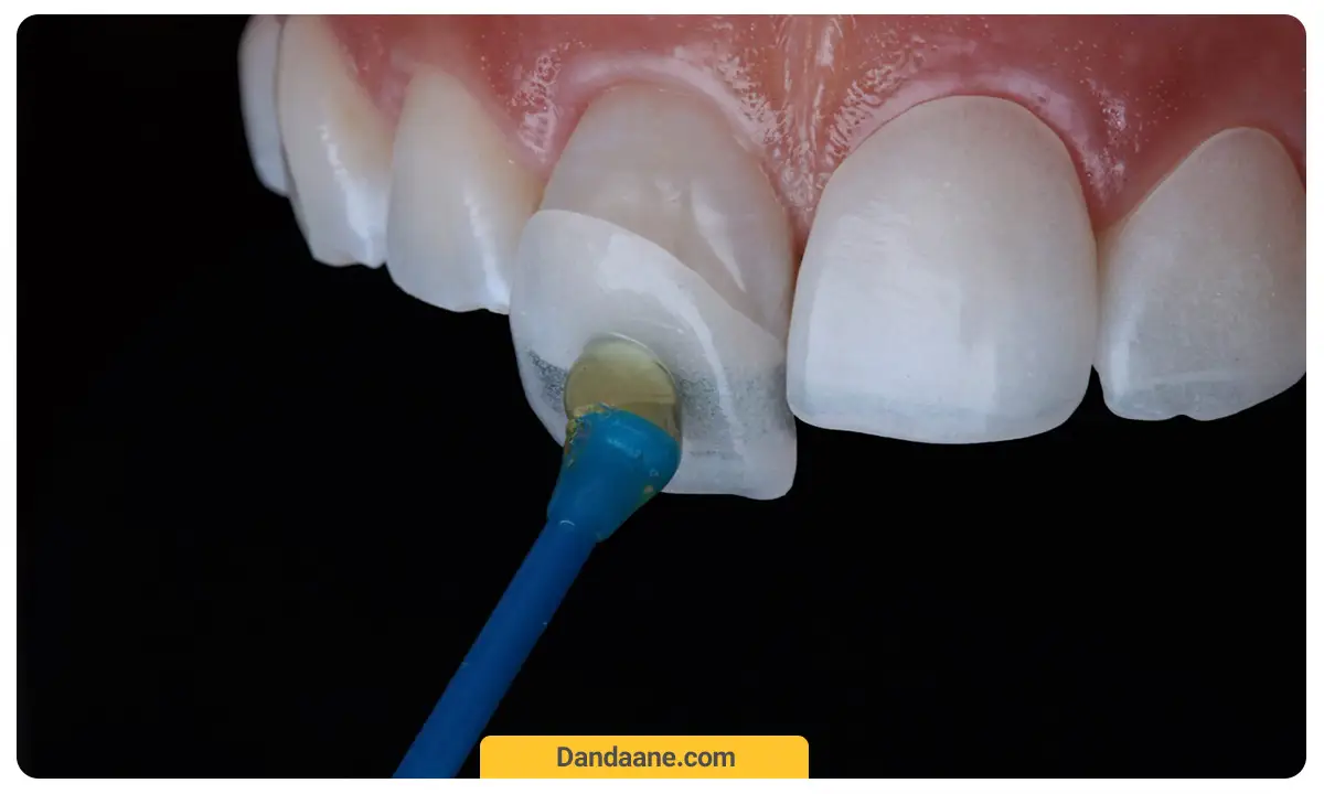 نصب لمینت دندان 