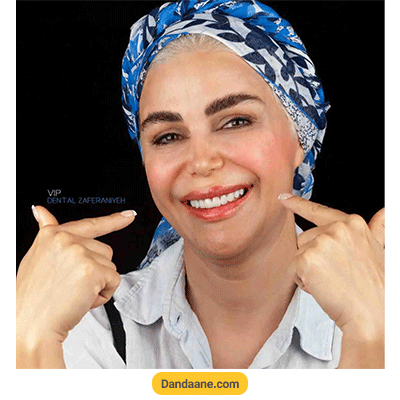 نمونه کار بعد کامپوزیت دندان کلینیک دندانپزشکی دنتال زعفرانیه