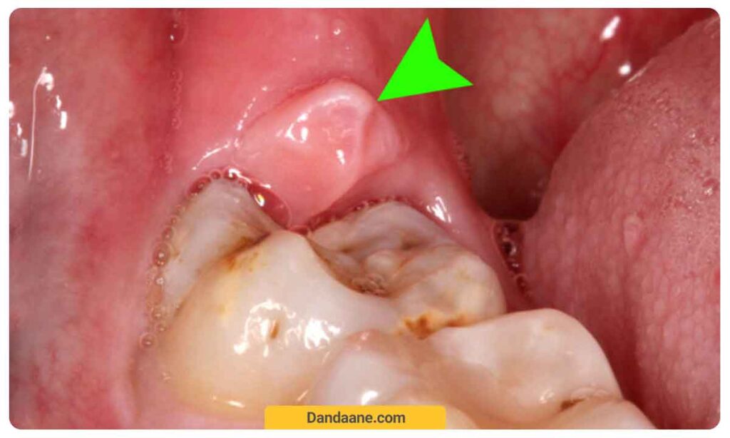 کیست دندان عقل نهفته