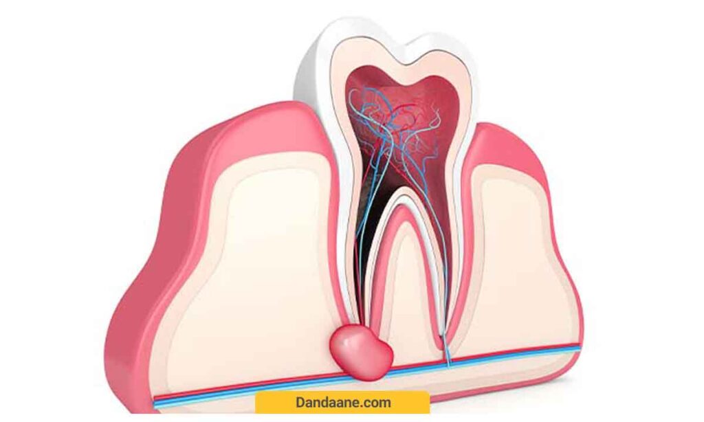 تصویر کیست دندان