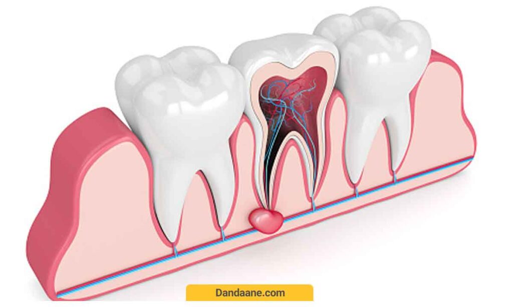 داروهای درمان کیست دندان
