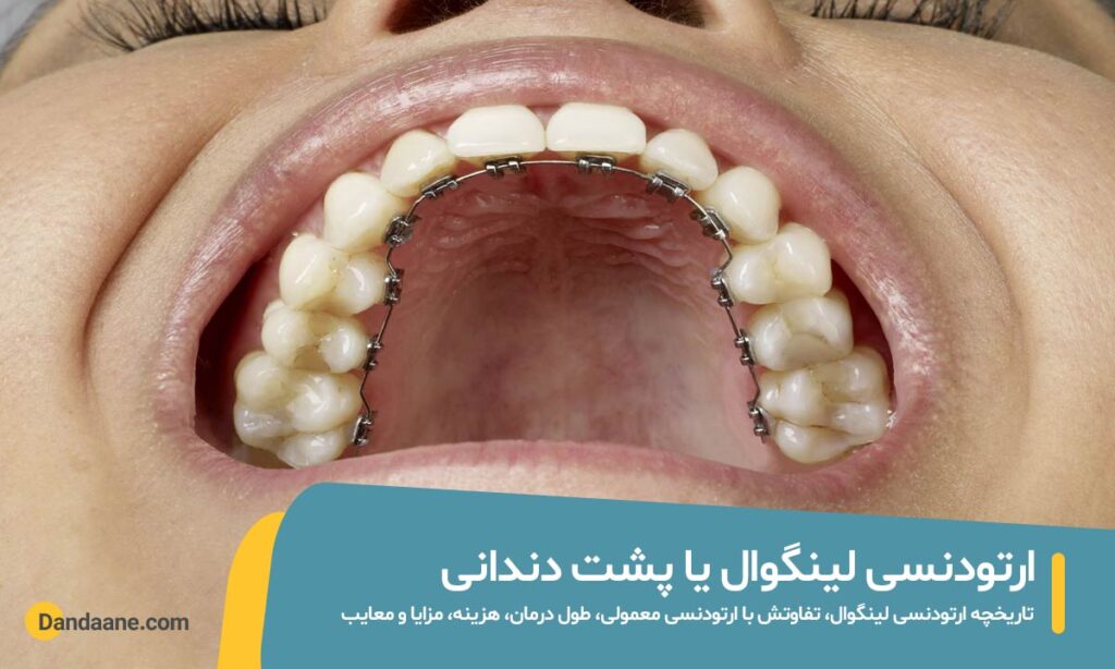 ارتودنسی لینگوال یا پشت دندانی