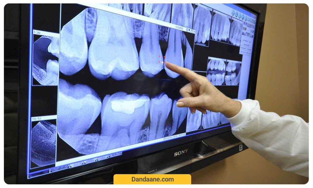 بررسی پوسیدگی های دندان از روی عکس opg