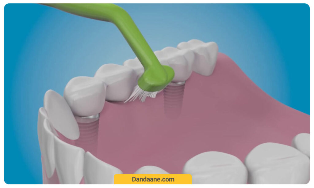 تمیز کردن دهان و دندان برای پیشگیری از عفونت ایمپلنت دندان