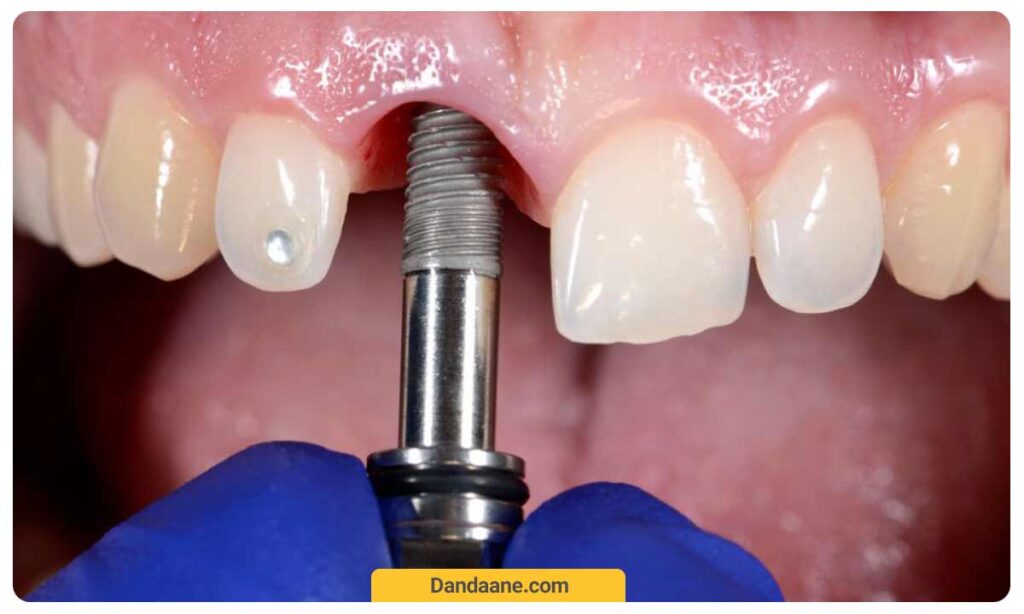 برداشتن ایمپلنت برای درمان عفونت ایمپلنت دندان