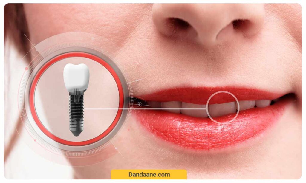 طول عمر ایمپلنت دندان بر اساس برند