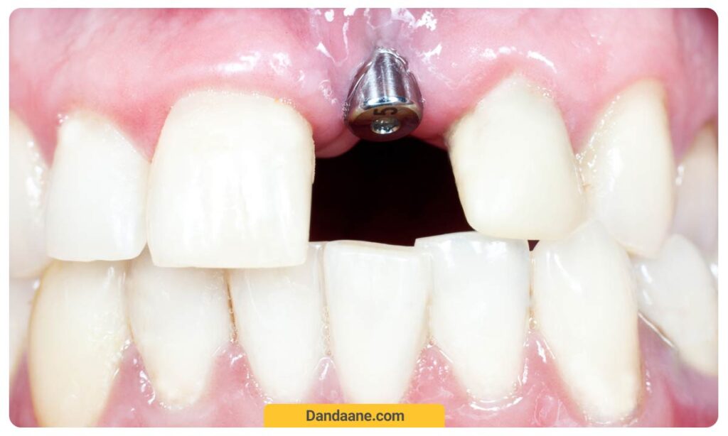تصویر پیچ ایمپلنت دندان جلو